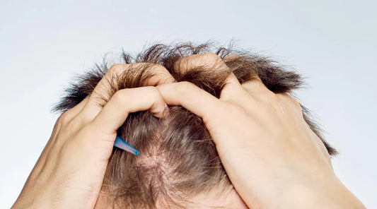 Coping with Hair Loss | Emotional Support & Wellness Tips