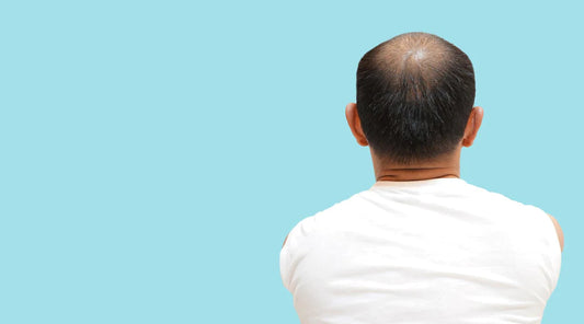 You're Not Alone: Understanding the Prevalence of Hair Loss